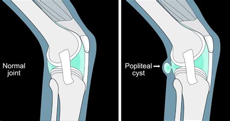 Quiste de Baker qué es y por qué sale un bulto detrás de la rodilla