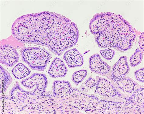 Normal Endocervix Shows Bland Columnar Epithelium Lining On Loose