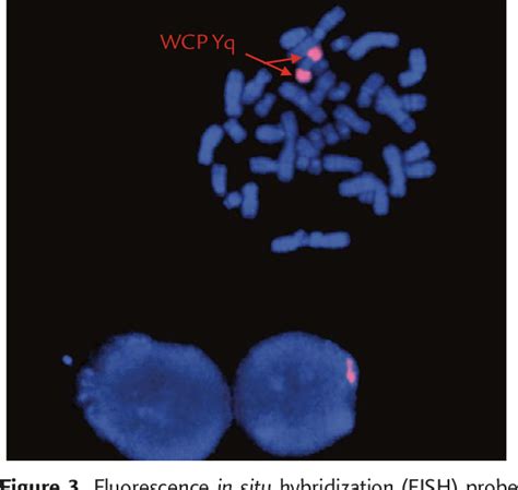 Pdf Delineation Of An Isodicentric Y Chromosome In A Mosaic 45x46xidicyqter P113p11