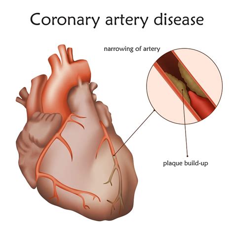 organicdietguide: Cholesterol & Blocked Arteries – Causes and Treatments