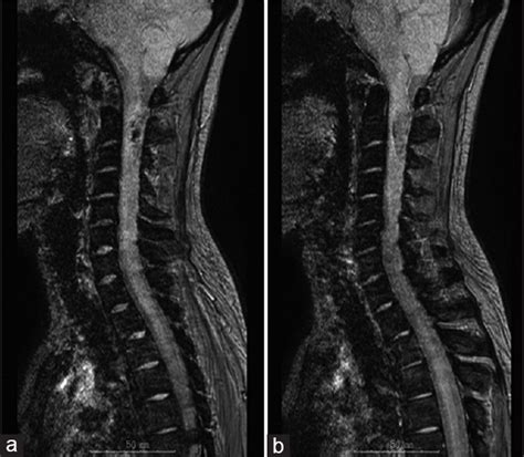 Intramedullary And Intratumoral Hemorrhage In Spinal Hemangioblastoma