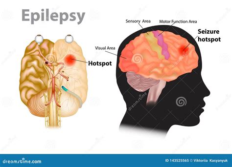 Medical Illustration Of A Brain With Epilepsy Stock Vector