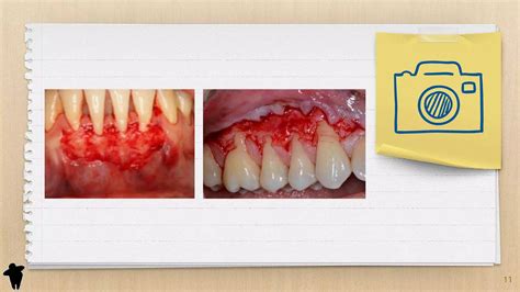 Resumo De Periodontia Classificação Dos Retalhos Periodontais Parte