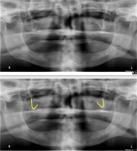 Anatomy Monday: Zygomatic Process of the Maxilla – Dr. G's Toothpix