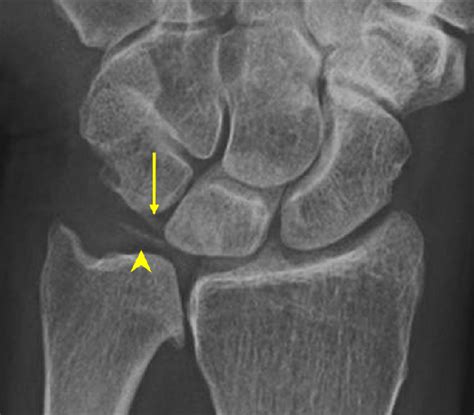 Chondrocalcinosis Wrist