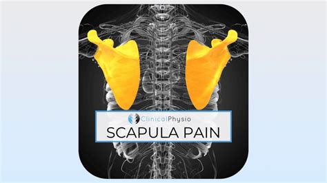 Scapula Pain – Clinical Physio Membership