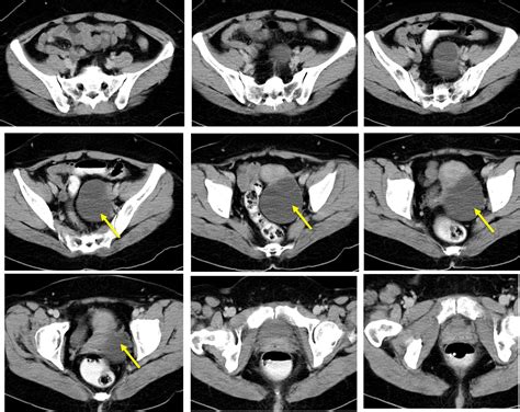 Ovarian Mucinous Cystadenoma Radiology Cases