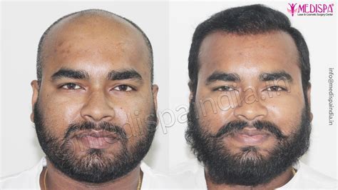 Bangalore Hair Transplant Results Hair Transplant Dubai Cost