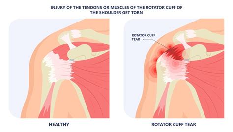 Glenoid Labrum Tear Treatment Las Vegas Bullhead City Mesquite Nevada