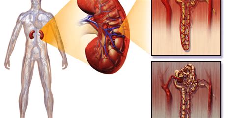 C Mo Se Puede Prevenir La Insuficiencia Renal Cr Nica