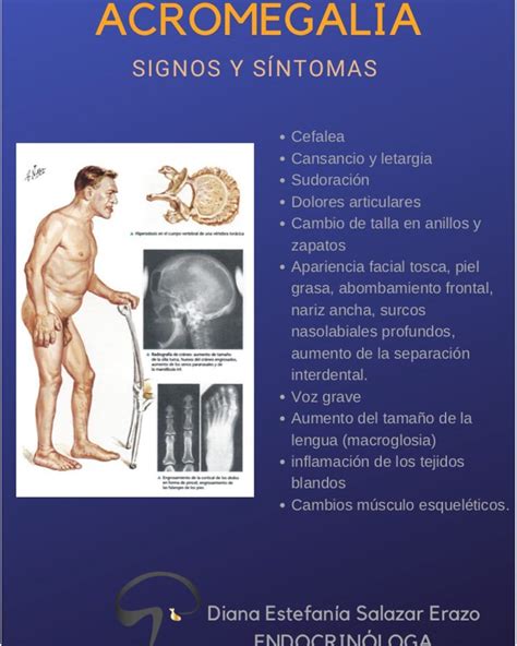 La Acromegalia Es Una Enfermedad Rara Que Necesita Un Diagn Stico