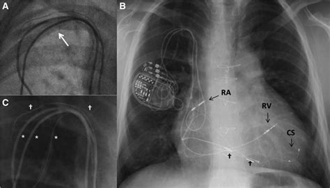 Femoral Transvenous Pacemaker