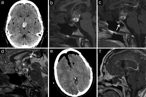 A Noncontrast Head Ct Shows A Heterogeneously Hyperdense Mass In The