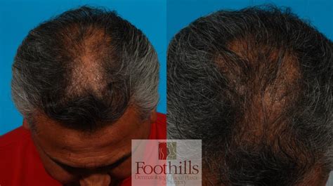 Prp Hair Restoration Before And After Photos Patient 106 Tucson Az