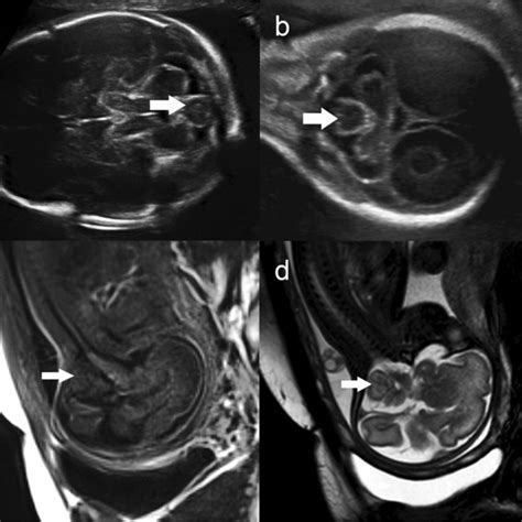 Enlarged Thickened Cerebellar Folia With Well Maintained Architecture