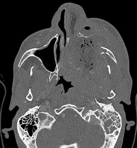 Axial Computed Tomography Scan Of The Sinuses Displaying A Large Left