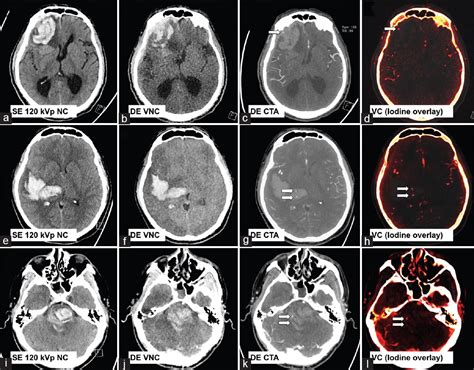 Principles And Clinical Application Of Dual Energy Computed Tomography