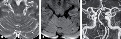 T2WI A And DWI B Show A Very Small Acute Infarct Black Arrow In