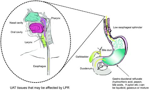 Mechanisms of LPR and LPR-related symptoms. Dysfunction of the lower ...