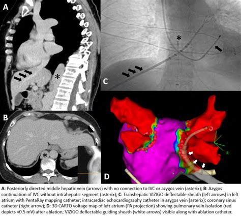 Percutaneous Transhepatic Venous Access And Use Of Visible Guiding