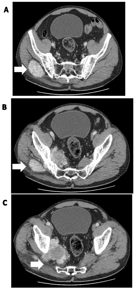 Cancers Free Full Text Diagnostics And Treatment Of Extrameningeal