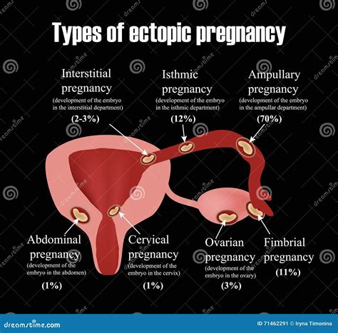 Types Of Uterine Fibroids Endometriosis Infographics Stock Vector