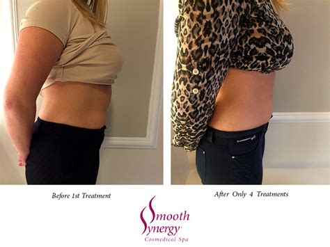 Ultrasonic Lipo Cavitation Treatments Smooth Synergy Medical Spa