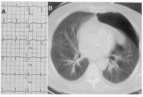 Twelve-lead ECG shows generalized low QRS voltage and QS configuration ...