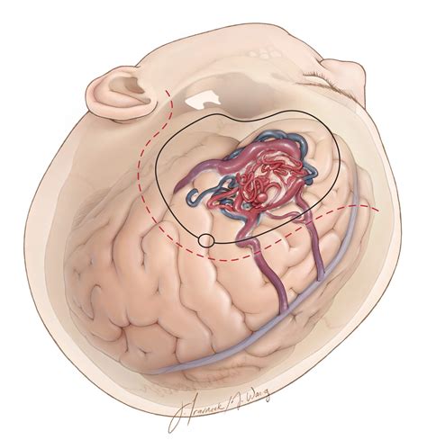 Nuances In Avm Resection The Neurosurgical Atlas By Aaron Cohen