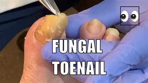 Thick Fungal Toenail Not Cut In 6 Months Youtube