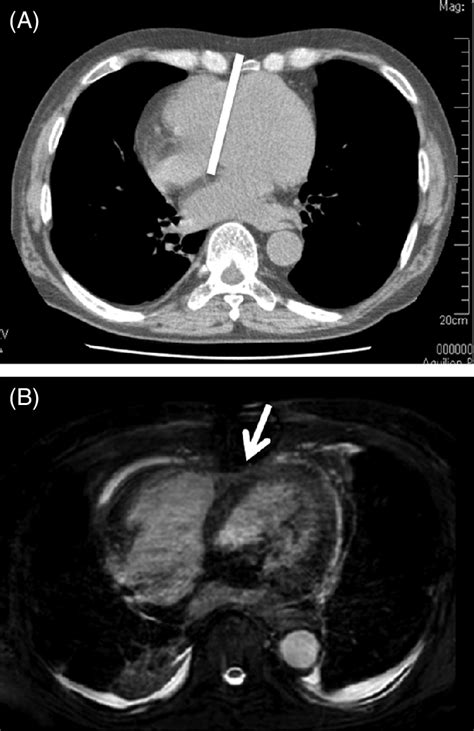 Computed Tomography Ct A And Magnetic Resonance Imaging Mri B Download Scientific