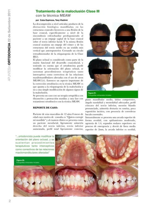 Tratamiento De La Maloclusión Clase Iii Con La Técnica Meaw Pdf