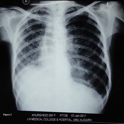 Pulmonary Tuberculosis Chest X Ray