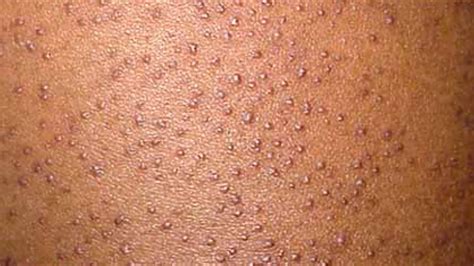 What Causes Keratosis Pilaris Skin