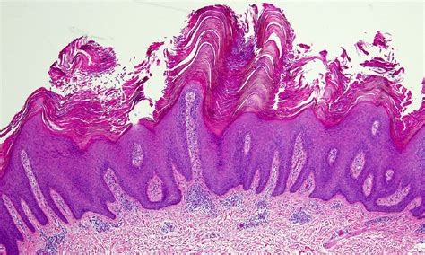 Epidermal Nevus Histology