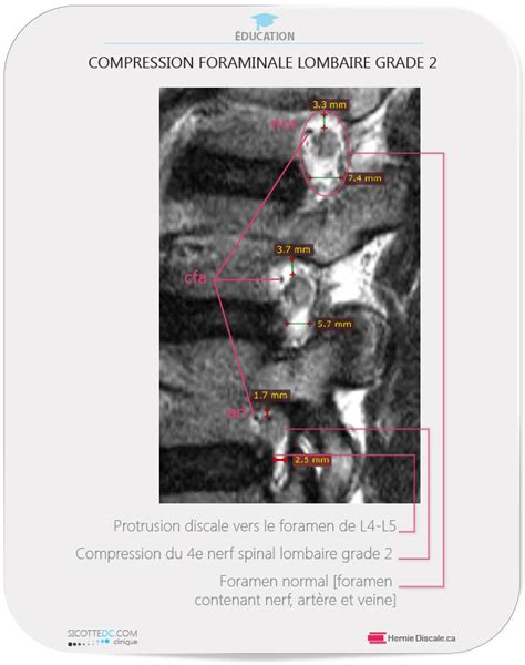 St Nose Foraminale Lombaire Sympt Mes Causes