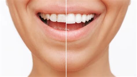 Myth Buster Popular Teeth Whitening Myths Debunked By Dental Expert