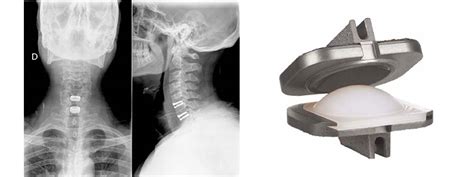 Pr Tesis De Disco Cervical Guillem Sal