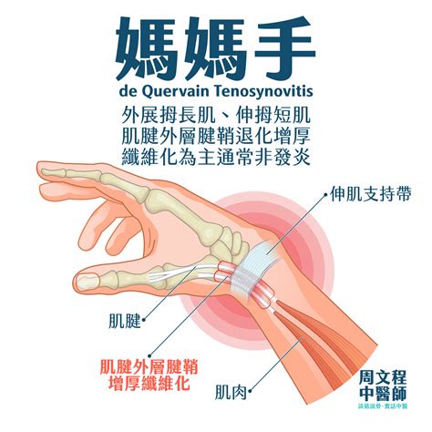 媽媽手是什麼 成因、測試及治療舒緩方案[2023版] 周文程中醫師