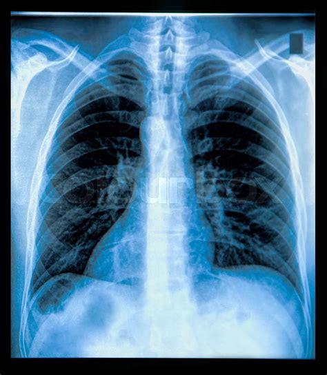 Chest X Ray Image Stock Image Colourbox