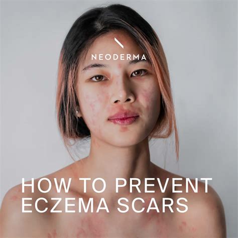 How to Prevent Eczema Scars – NEODERMA