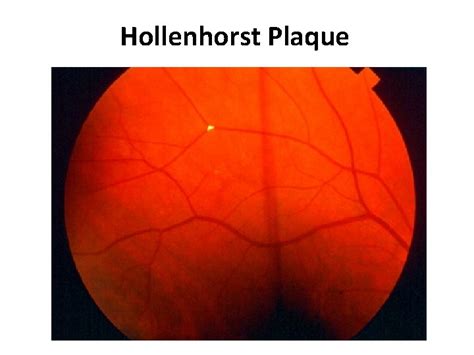 Stanford Medicine 25 Fundoscopy Papilledema Fundoscopic Findings Venous