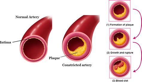 The Difference In Normal Artery And Constricted Artery The Left Artery