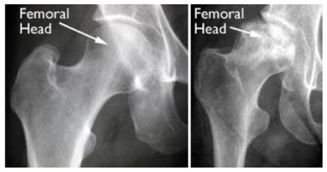 Osteonecrosis Of The Hip