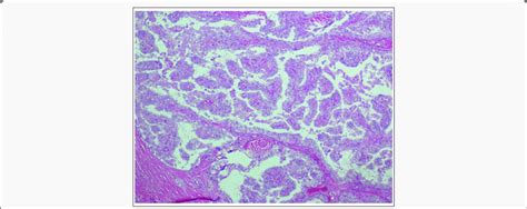 Papillary thyroid carcinoma. Papillae with ground glass (Orphan Annie... | Download Scientific ...