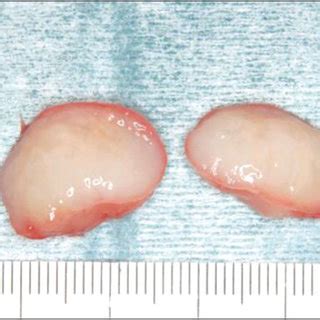 Gross Appearance Of The Resected Specimen A The Surgical Specimen