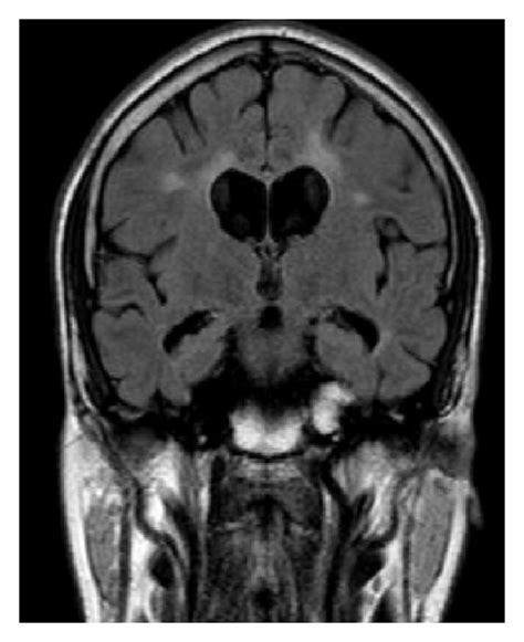 A And B Axial T2 Mri Shows Multiple Periventricular And Juxtacortical Download Scientific