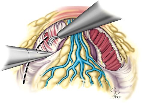 Laparoscopic And Robotic Assisted Radical Cystectomy For Bladder Cancer