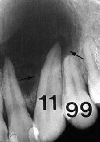 Case Periapical Radiograph Shows A Radiolucency About Cm In