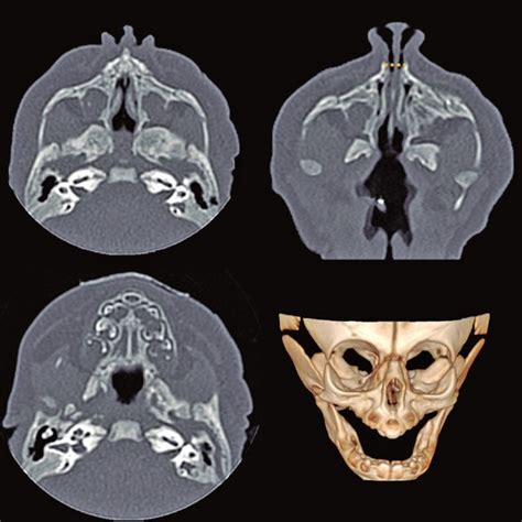 Axial Computed Tomography Scan Sections Of Paranasal Sinuses A Open